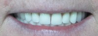 Estetska stomatologija-poslije 6